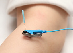 通電（パルス）鍼